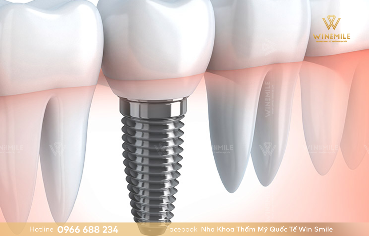Trồng răng Implant là giải pháp tối ưu được chuyên gia khuyên nên chọn