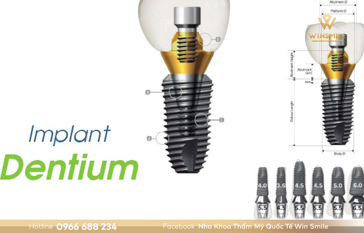 Trụ Dentium được khách hàng đánh giá cao nhờ khả năng tích hợp tốt
