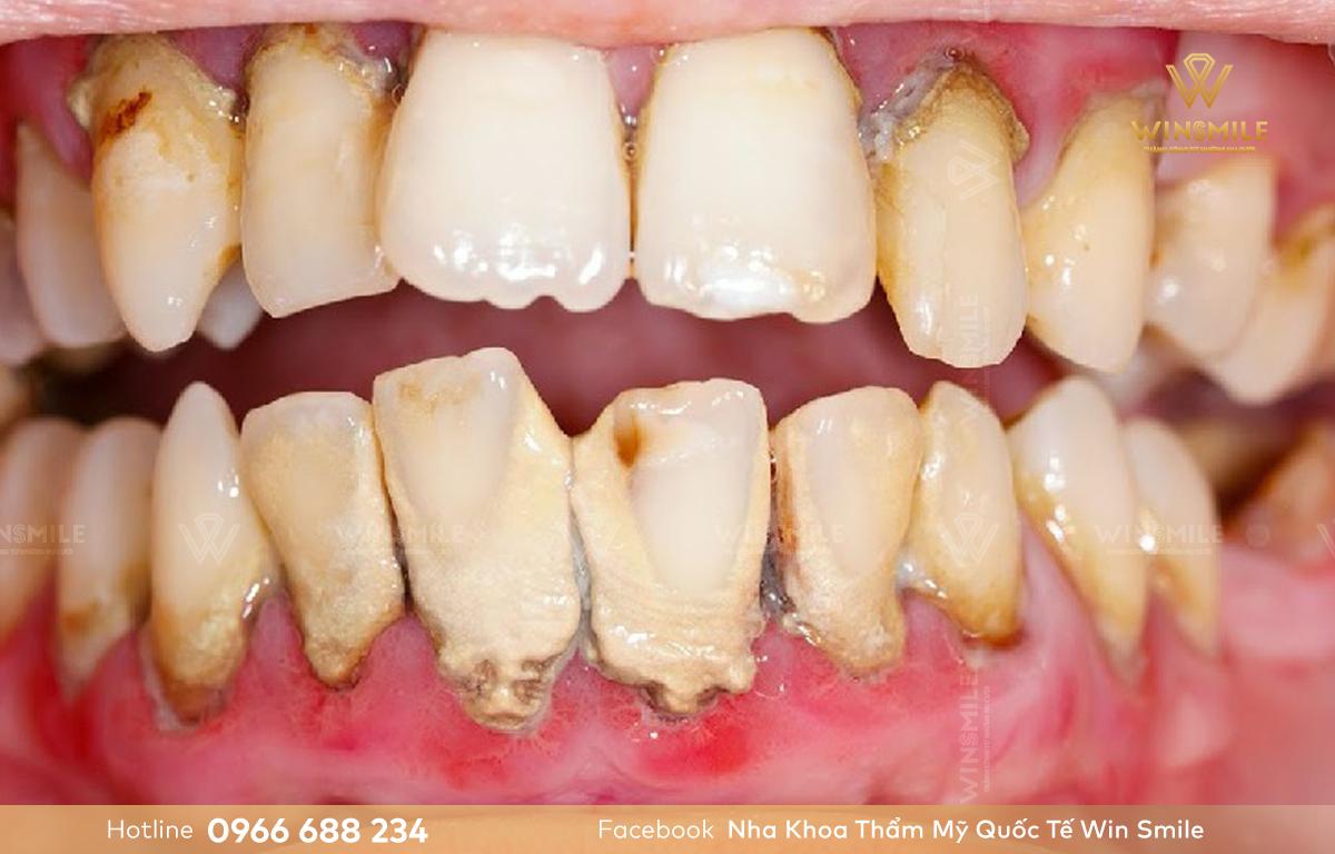 Viêm nha chu là nguyên nhân gây mất răng