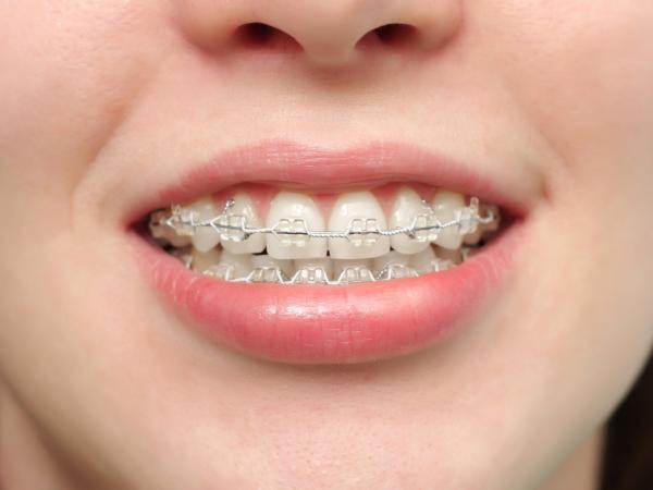 Trồng răng Implant Straumann