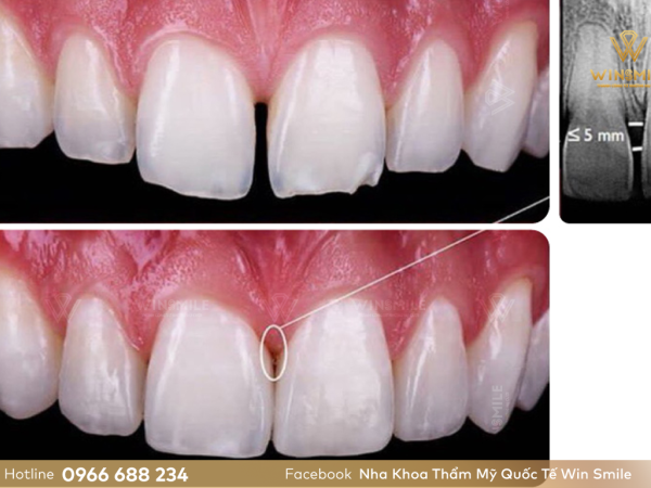 Tại sao hàn răng thưa bằng Composite được ưa chuộng hiện nay?