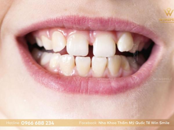 Tại sao răng thưa - 4 nguyên nhân chính và cách khắc phục