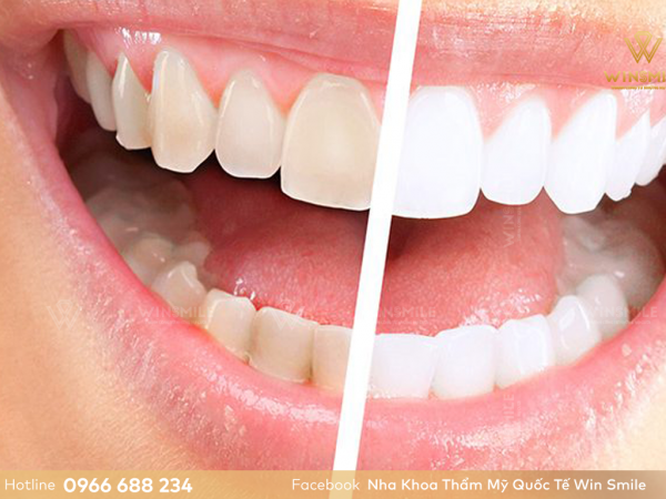 Chi phí tẩy trắng răng bao nhiêu? Các yếu tố ảnh hưởng đến giá tẩy trắng răng