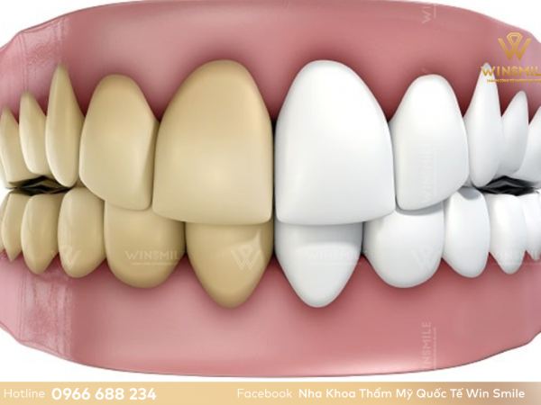 Tẩy trắng răng có bị vàng lại không? Chuyên gia giải đáp