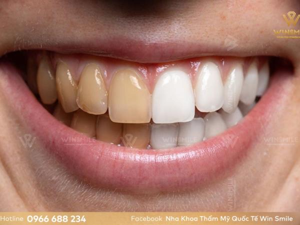 Tẩy trắng răng duy trì được bao lâu? Nên làm gì để giữ được hàm răng trắng sáng