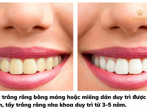 Tẩy trắng răng giữ được bao lâu? Mẹo chăm sóc sau tẩy trắng giúp răng luôn bền sáng