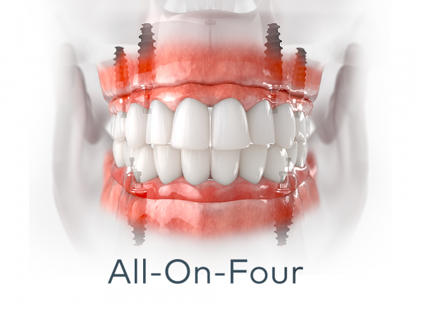 Trồng răng Implant toàn hàm All on Four