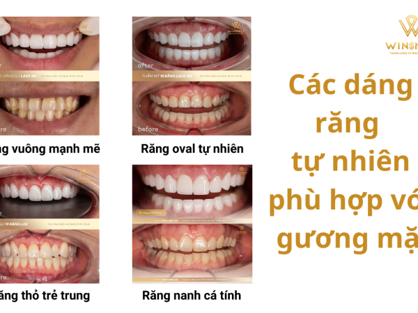 Nên chọn dáng răng nào cho tự nhiên khi thẩm mỹ răng sứ?