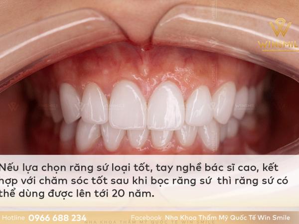 Bọc răng sứ dùng được bao lâu? Cách chăm sóc răng miệng để kéo dài tuổi thọ răng sứ