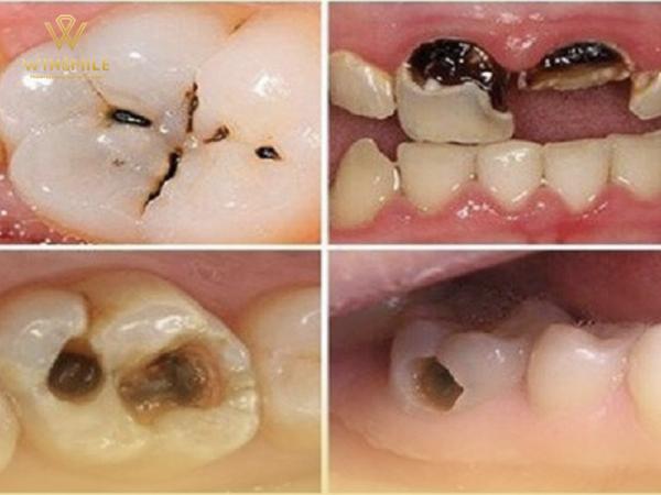 Sự thật về bệnh sâu răng, biến chứng và cách điều trị