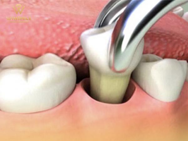 Cẩn trọng với 4 biến chứng nhổ răng thường gặp