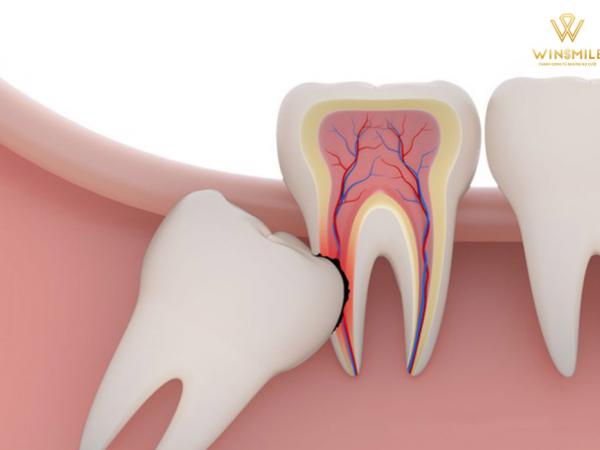 Biến chứng nhổ răng số 8 - Các vấn đề nguy hiểm có thể xảy ra