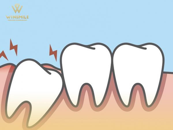 Cảnh báo 5 biến chứng răng số 8 nguy hiểm thường gặp