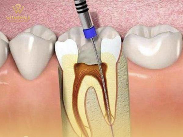Loại bỏ ngay biến chứng sau khi lấy tủy răng với quy trình chuyên nghiệp 