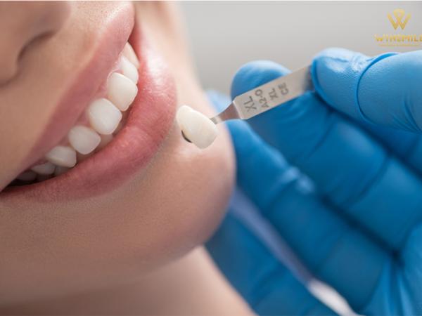 Từ A đến Z thông tin về bọc răng sứ thẩm mỹ
