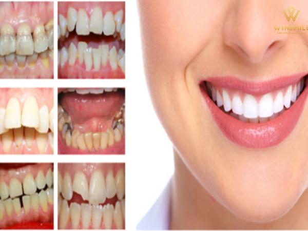 Bọc răng sứ thẩm mỹ có tốt không mà được nhiều người lựa chọn?