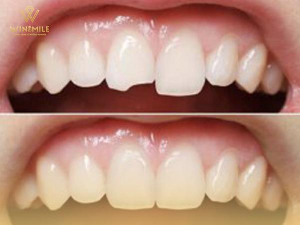 Bọc sứ răng cửa bị mẻ - Bước đơn giản giúp diện mạo hoàn hảo hơn