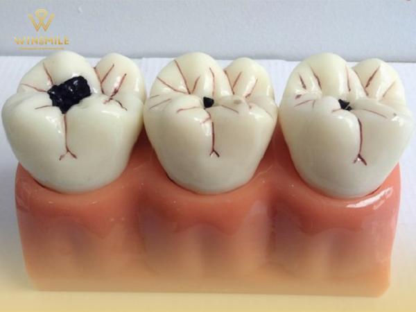Giải pháp bọc sứ răng sâu cho hàm răng chắc khỏe không bệnh lý