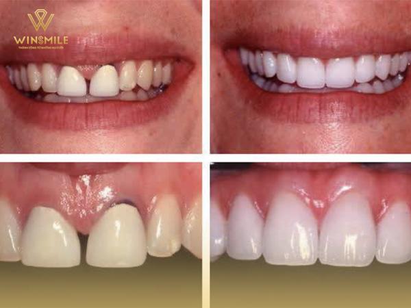 Bọc sứ răng thưa - Giải pháp tuyệt vời khắc phục khuyết điểm răng