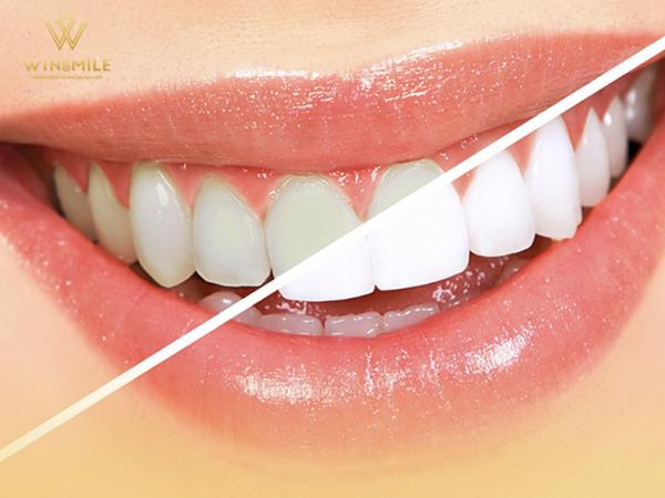 Cách làm răng sứ trắng - Bật mí các tips hiệu quả