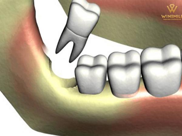 TOP 8 cách chăm sóc bệnh nhân sau nhổ răng