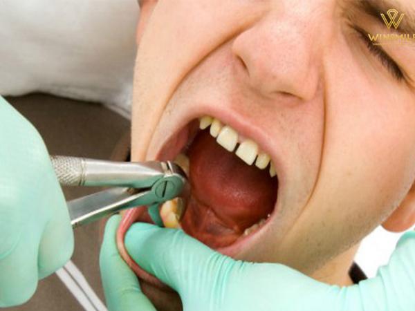 Mách bạn cách chăm sóc sau nhổ răng giúp hồi phục nhanh chóng