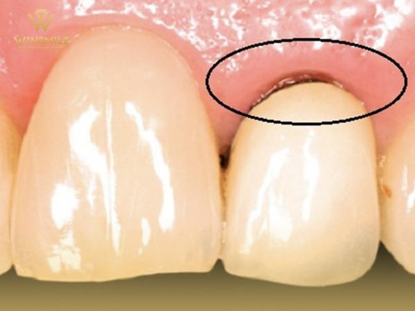 Đừng để chân răng bọc sứ bị đen làm ảnh hưởng sức khỏe răng miệng 