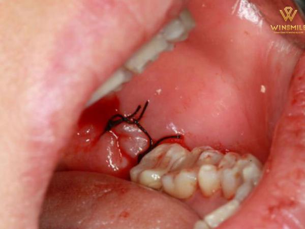 Đừng chủ quan với tình trạng chảy máu sau nhổ răng khôn 