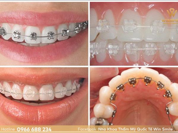 3 Loại chỉnh nha mắc cài bạn cần biết trước khi thực hiện niềng răng