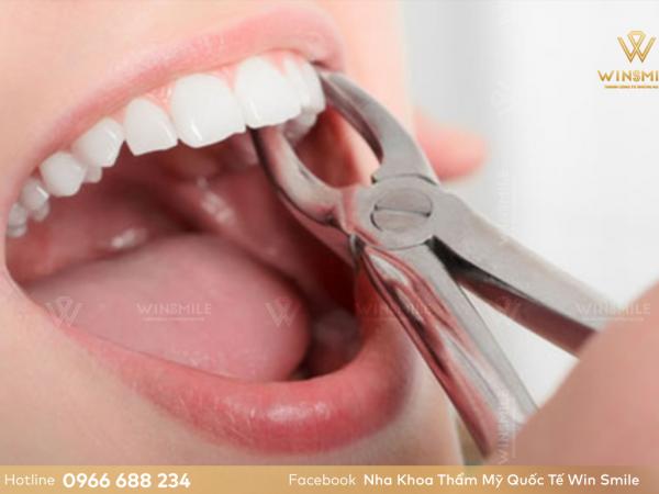 Chỉnh nha nhổ răng khi nào? Nhổ răng số mấy? Có nguy hiểm không?
