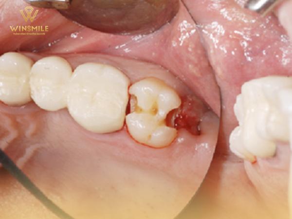 Có nên nhổ răng khôn? - Quyết định giúp cải thiện sức khỏe răng miệng của bạn