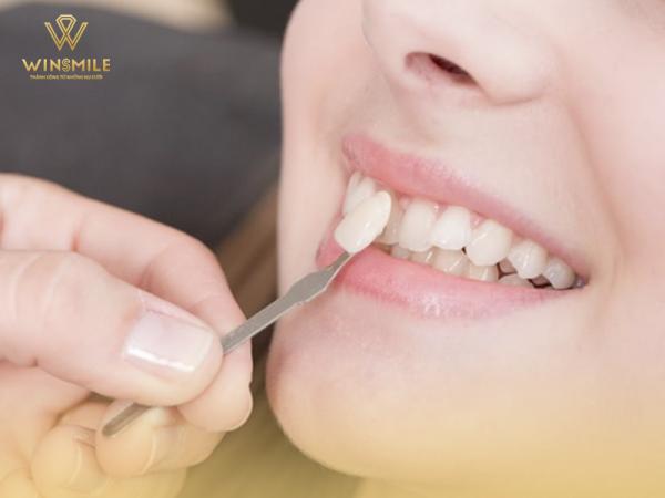 Dán răng sứ - Phương pháp thẩm mỹ răng ít nhược điểm nhất