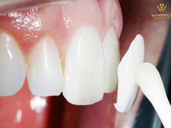 Dán sứ răng - Phương pháp thẩm mỹ răng không xâm lấn và hiệu quả cao