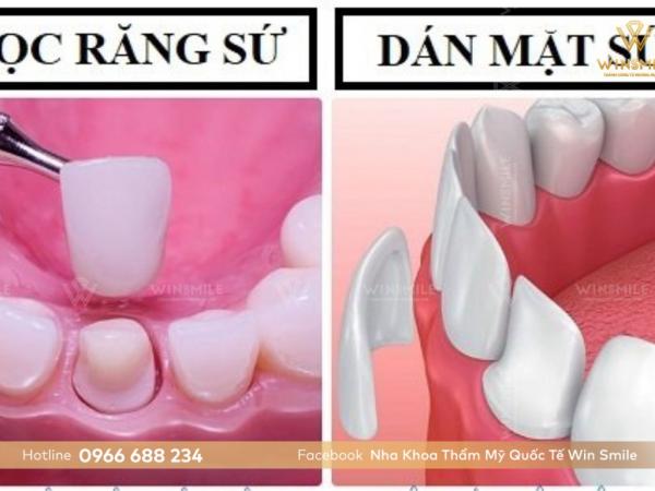 Nên bọc răng sứ hay dán sứ? Bật mí cách để có lựa chọn phù hợp?
