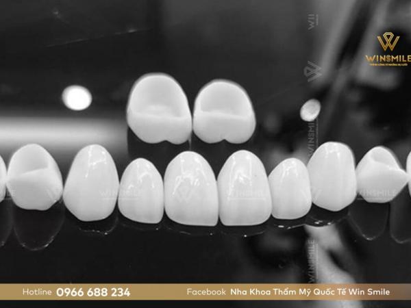 Dán răng sứ veneer có mấy loại? Ưu nhược điểm của các loại sứ veneer là gì?