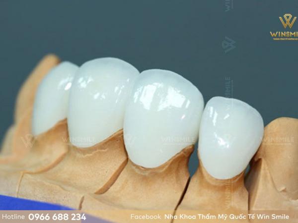 Răng sứ Lava Plus 3M - Răng sứ cao cấp nhất của Mỹ có ưu điểm gì? 