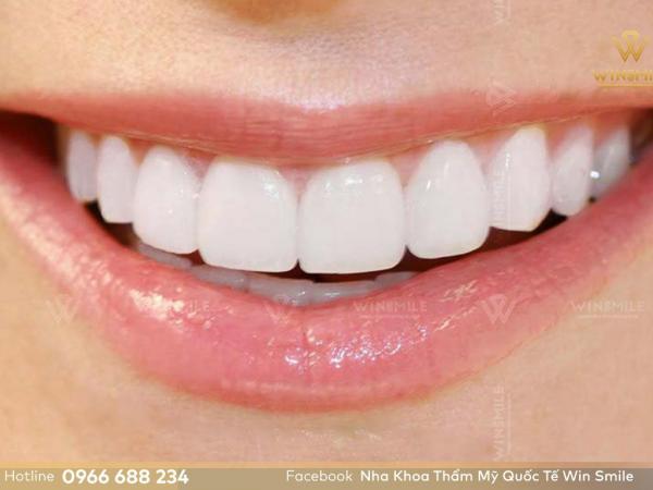 Cập nhật bảng giá răng sứ Lava Plus mới nhất tại nha khoa Win Smile