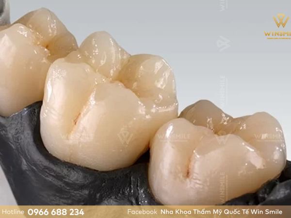 Răng sứ Ceramill có mấy loại? Nên chọn loại răng sứ Ceramill nào?