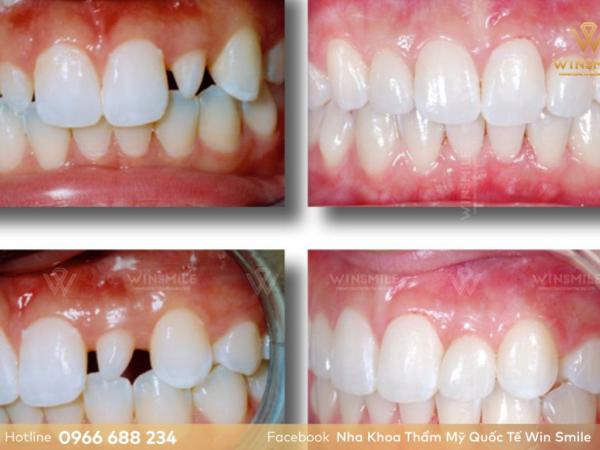 Mách bạn 4 cách khắc phục răng thưa hiệu quả nhất hiện nay