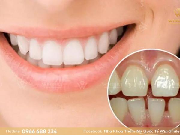 Tại sao răng bị thưa dần? Nên làm gì để khắc phục?