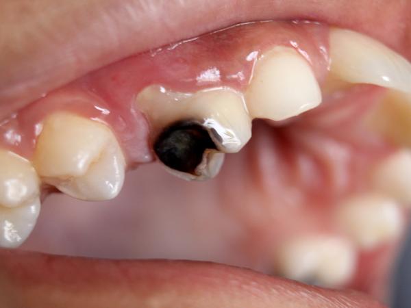 Điều trị răng sâu