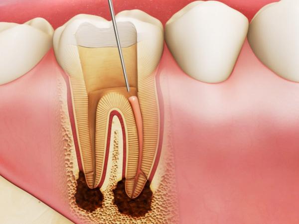 Những điều cần biết khi điều trị tủy răng