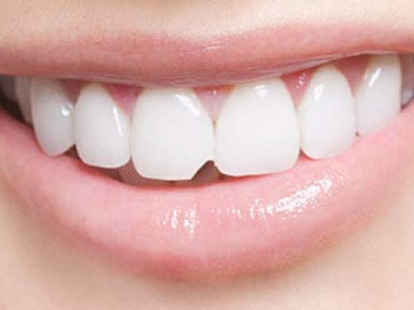 Hàn trám răng thẩm mỹ - Giải pháp hiệu quả cho răng khuyết điểm