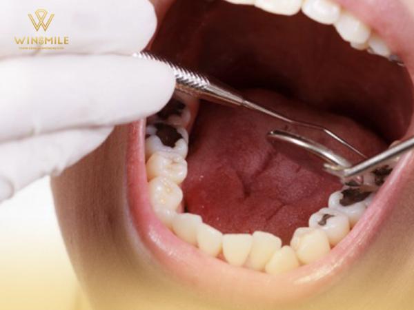 Chỉ 7 cách điều trị sâu răng tại nhà mang đến hiệu quả tức thì