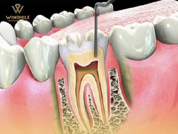 Lấy tủy răng đau không? Phương pháp điều trị hiệu quả cao