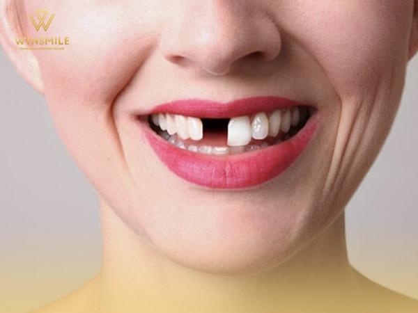 Nguyên nhân và cảnh báo hậu quả khôn lường do mất răng gây ra