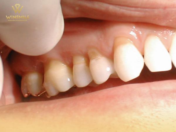 Những nguyên nhân không tưởng gây mòn răng và cách điều trị