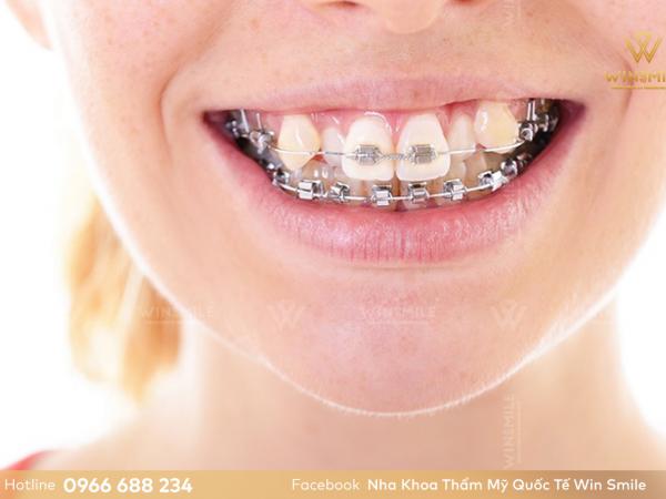 Niềng răng khấp khểnh bằng loại mắc cài nào tốt nhất hiện nay?