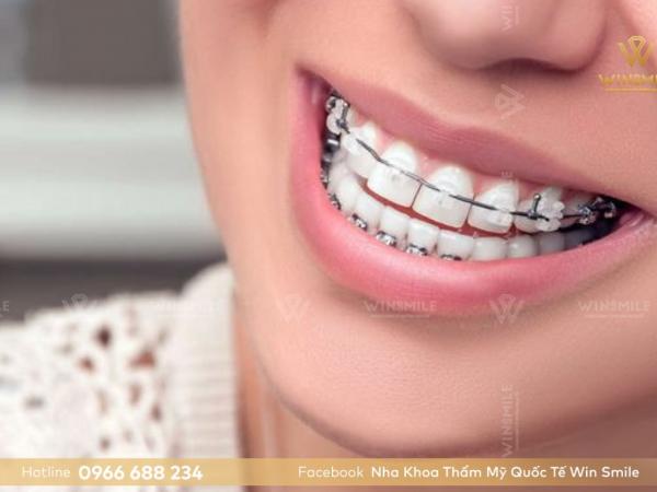 Niềng răng móm mất bao lâu? Phụ thuộc vào yếu tố nào?