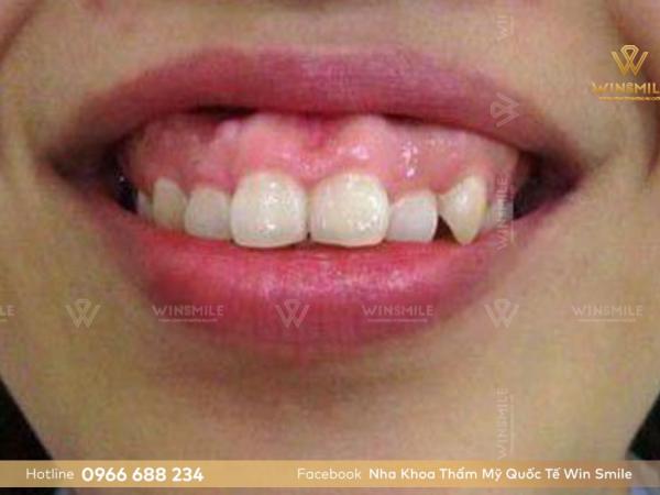 Răng hô vẩu và cách phân loại, điều trị
